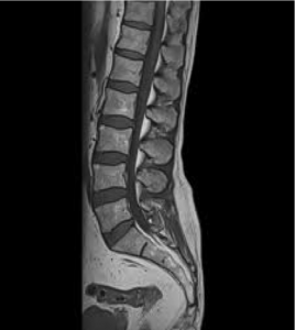 This is an MRI of the spine