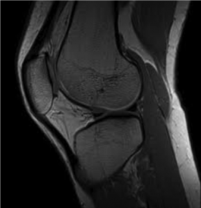 This is an MRI image of the knee