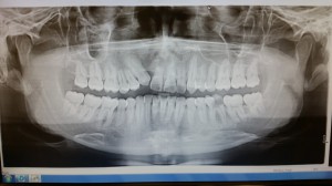 24 year old, no systemic conditions. Patient presented with history of maxillary cyst, removed along with the extraction of tooth #7 in order to open up space for drainage. This resulted in a severe amount of bone loss around the area of #6, arch form asymmetry. Tooth #6 was facially inclined and had heavy subgingival and supragingival calculus mainly on the lingual surface. Advised the patient to use an end tuft brush to brush around that area. 