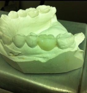 my_wax_tooth