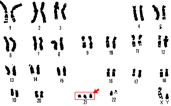 Fig. 3. Karyotype of a human male with Trisomy 21 (Down syndrome). Note the three copies of Chromosome 21. Homologous chromosomes were determined by size and banding pattern.