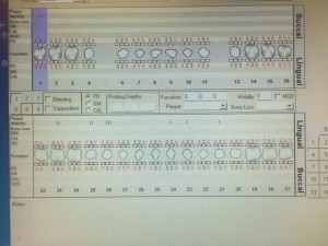 Pt is a 35 year old male. Type III periodontal class. This shows his probe reading prior to quadrant scaling therapy.