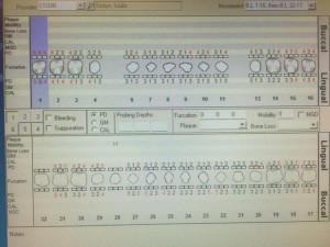 These are probe readings at his 3 month recall. With treatment and increased oral hygiene at home we were able to reduce the depth of many pockets.