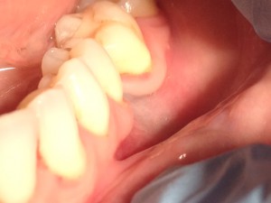 Pt was a 32 year old white female. EO/IO exams were within normal limits, bony defect was noted on the LL quadrant.