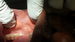 This was one of the cases that I worked on. A man who continually bit his cheeks.