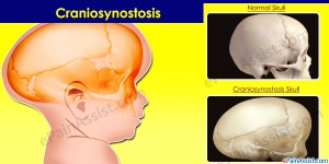 craniosynostosis (1)