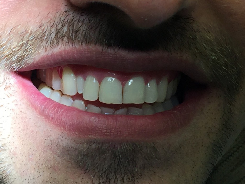 Pt. A.S was seen in 2015 and an extra lateral incisor was noted.