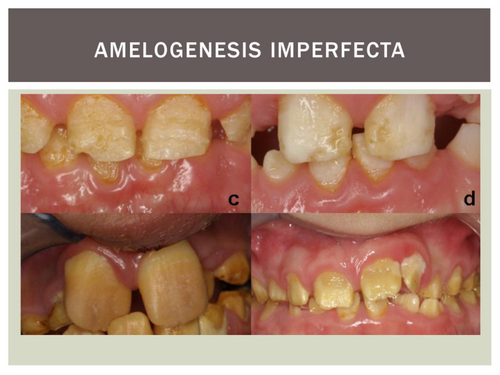 amelogenesis imperfecta eportfolio-page-003
