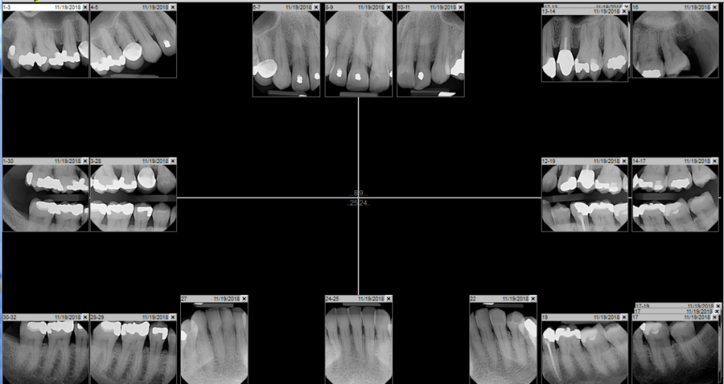 Clinical Case Study II- Arestin Placement | Ruth Pierre's ePortfolio