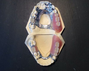 Completed partial denture