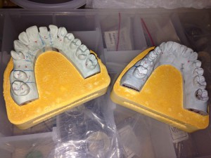 Maxillary and mandibular models ready for dies to be cut and mounted on articulator.