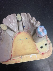 Build up of dentin and enamel.