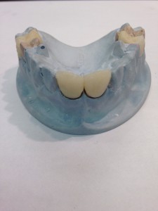 E.max crowns with porcelain build up, glaze and staining.