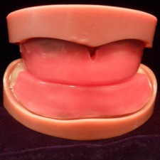 Complete Dentures RESD 2311