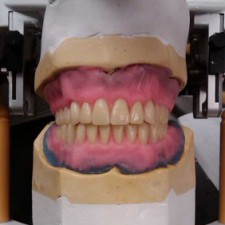 RESD Complete Dentures I